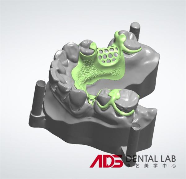 ADS Dental Lab Partial Metal Frame Denture Framework Fabrication