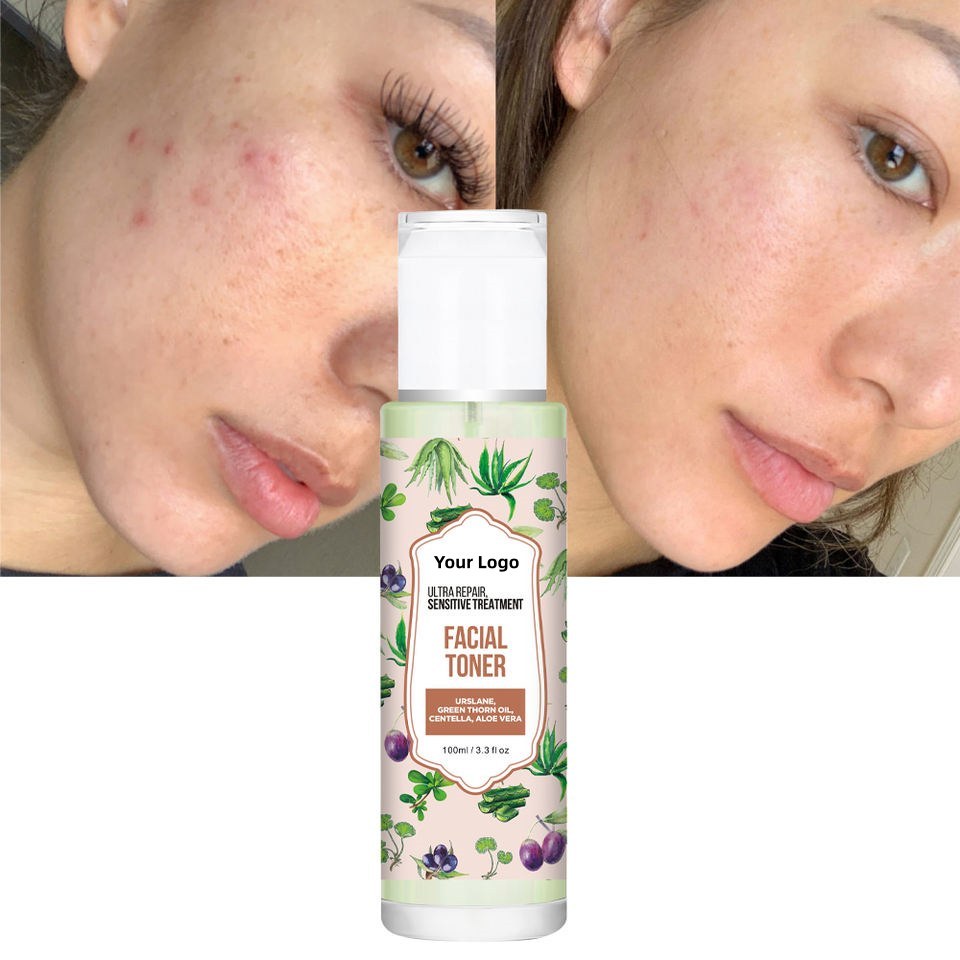 OEM ODM Sensitive Skin Care Brand Natural Facial Toner Redness Alleviation Anti allergy Moisturizing Facial Toner Soothing spray