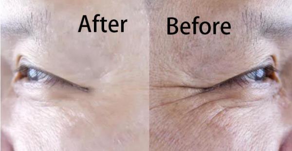 Hyaluronic Acid Filler Collagen Regeneration Whitening And Anti Aging Injection