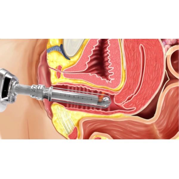 40W Fractional Co2 Laser Equipment With Metal Tube Laser Clinic Use