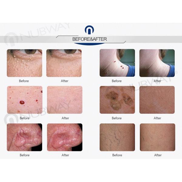 Factory Price Spider Vein Removal Machine / Veins Removal Machine / Facial Vein Removal