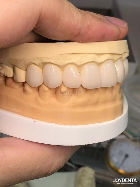 16 Shades Color Emax Dental Veneers A1-A4 High Stain Resistance For Perfectly Smiles