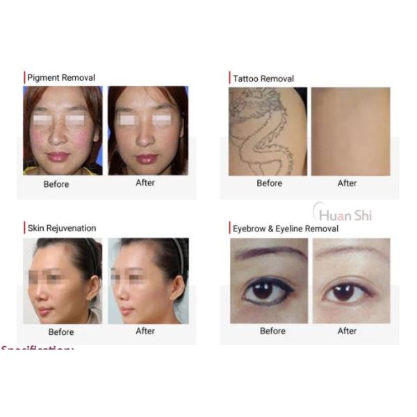 Лазер удаления 1064nm 532nm 755nm Pico пигмента удаления татуировки пикосекунды Машина лазера пикосекунды лазера yag nd машины удаления татуировки удаления 1064nm 532nm пигмента удаления татуировки пикосекунды