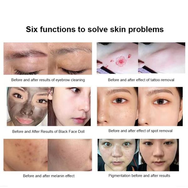 Gomecy Carbon Laser Peeling Machine Whitening Face Ndyag Лазерная машина для ухода за красотой