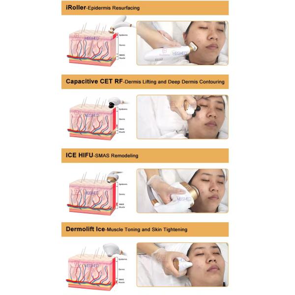 Hifu helado Refrigeración facial y corporal Radiofrecuencia Elevación facial Cryo Hifu Máquina Smas Apretamiento de la piel