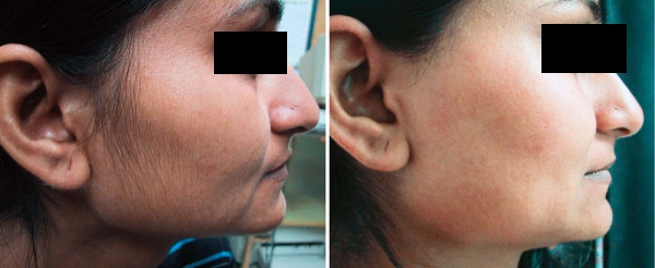 2000w 950nm Permanent IPL Hair Removal Machine