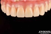 Dental Treatment High Elasticity Acrylic False Teeth Finish For Tooth Arrangement