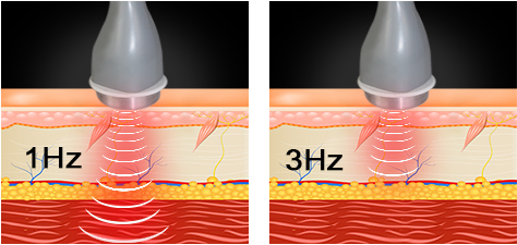 Машина физиотерапии ультразвука мышцы совмещает терапию ударной волны для облегчения боли