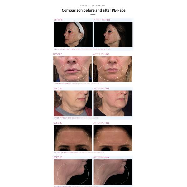 Подниматься стороны удаления морщинки RF EM-стороны затягивает тонкую машину потери веса машины стороны неинвазивную для салона