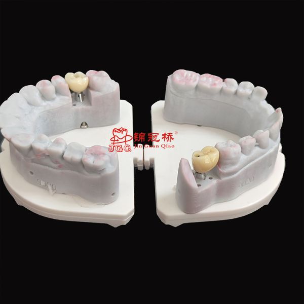 Customized Dental Crown and Implant with CE FDA Certification Using 3D Laser Printing Technology