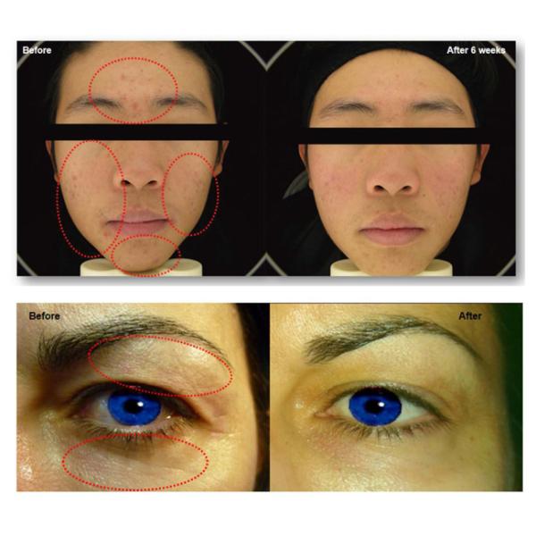 50 / 60HZ Multifunctional Beauty Machine Acne Scar Treatment No Consumption