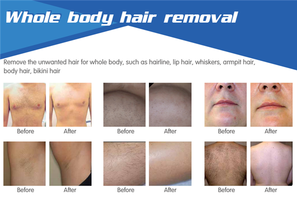 manufacturers supply portable diode laser painfree effective 810nm high power laser diode