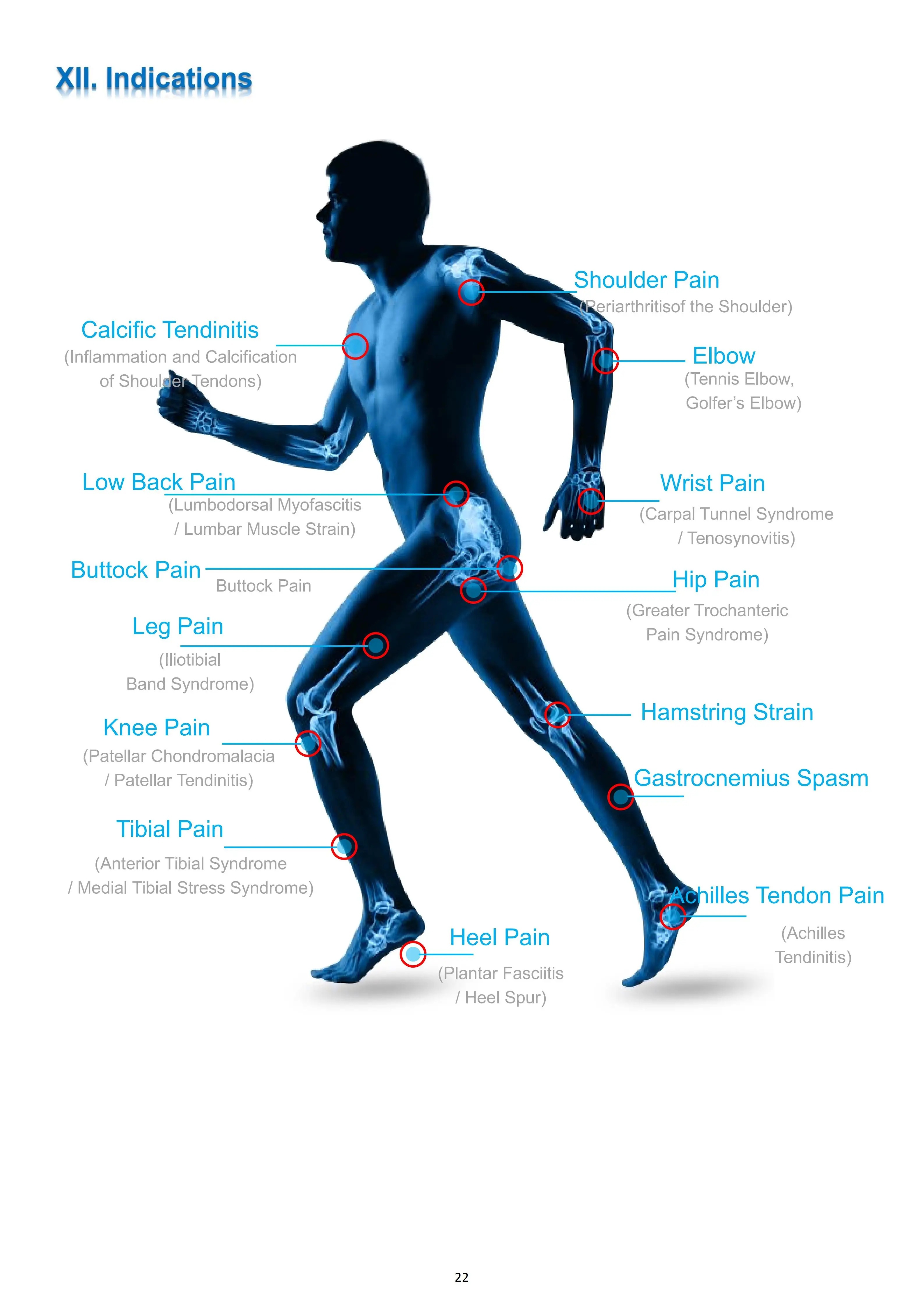 Electromagnetic Focused Shock wave Therapy Device for Musculoskeletal And ED Treatment