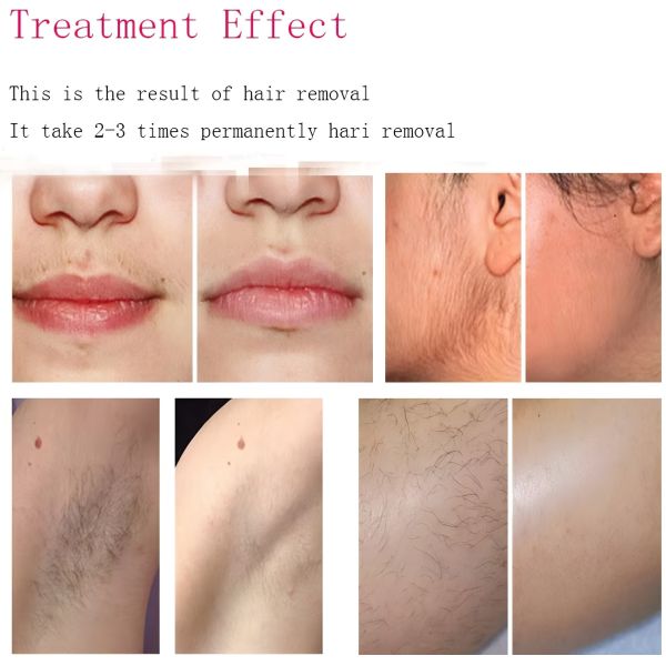 Beauty Salon Laser Hair Removal Machine Triple Wavelength Diode Laser Machine