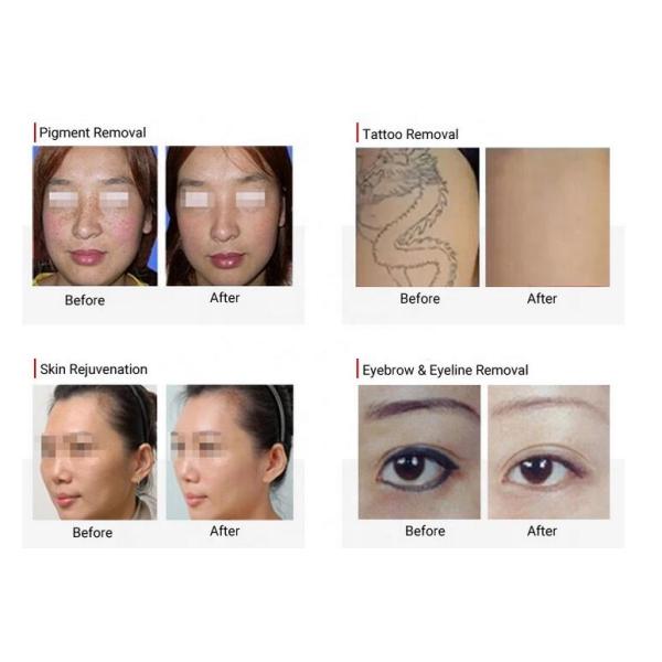 Stationary Q Switched Nd Yag Laser Machine For Tattoo / Freckle / Pigment Removal