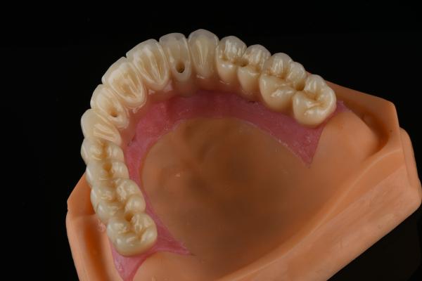 Roughened Surface Titanium Dental Implants Surgery For Front Tooth Replacement
