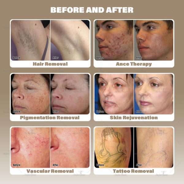 5 In 1 Laser Hair Tattoo Removal Treatment Multifuntional Cost Effective Nd Yag Picosecond