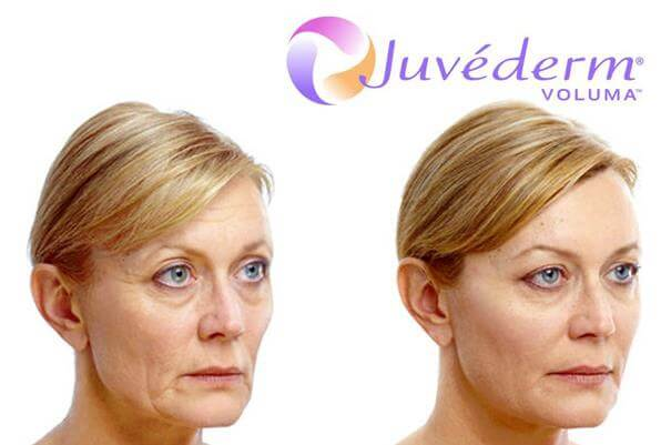 Заполнитель губы Ultra3 Voluma Hyaluronic кисловочный для Unisex увеличивая губ с продолжительным
