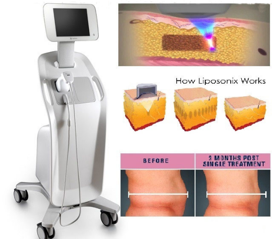 hifu lipo machine weight loss slimmimg hifu slimming machine
