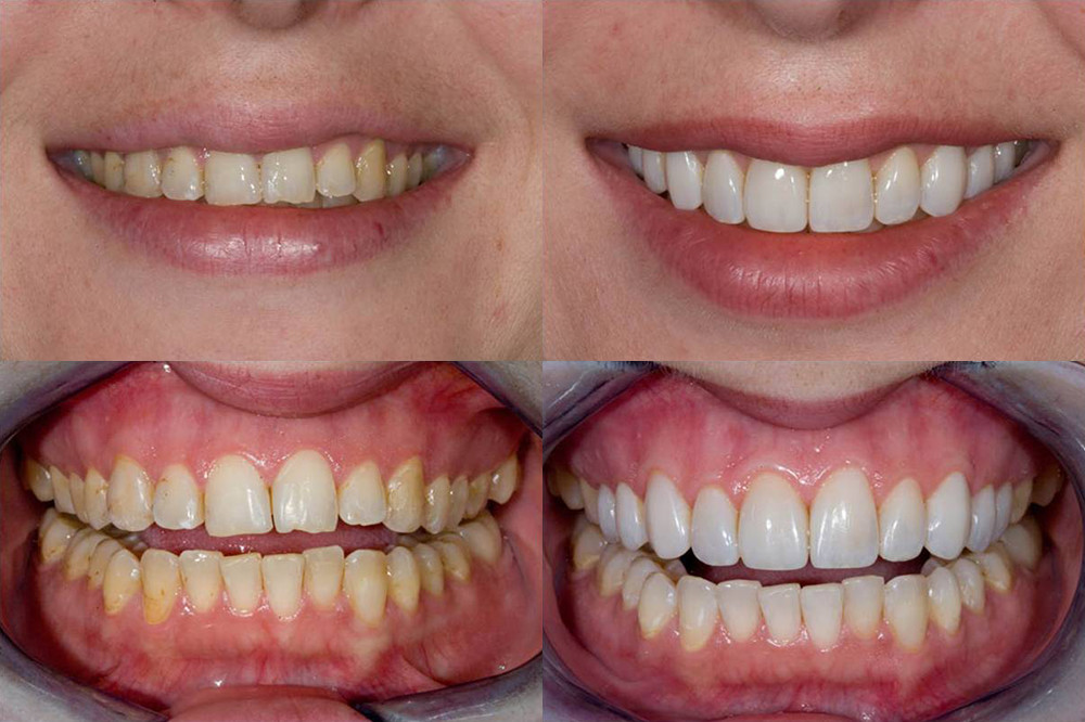 Zirconia 10mm керамический просвечивающий преграждает 10 слитков PCS IPS Emax