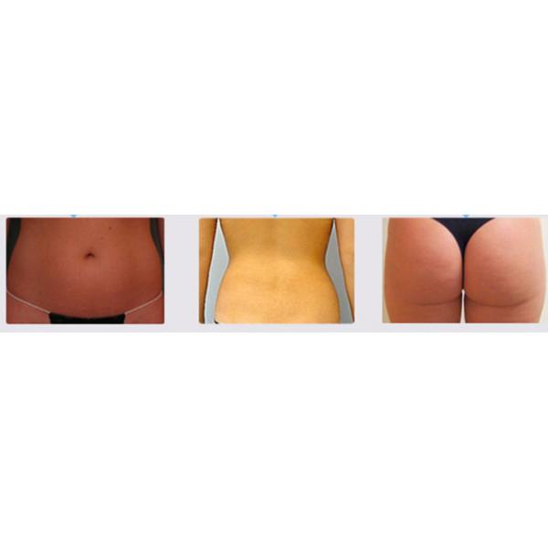 Skin tightening U Shape focused ultrasound slimming machine with CE Approved
