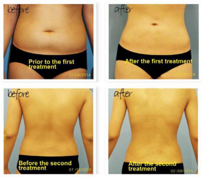 weight lose Vacuum Slimming Machine Physical and Effciency Liposonix