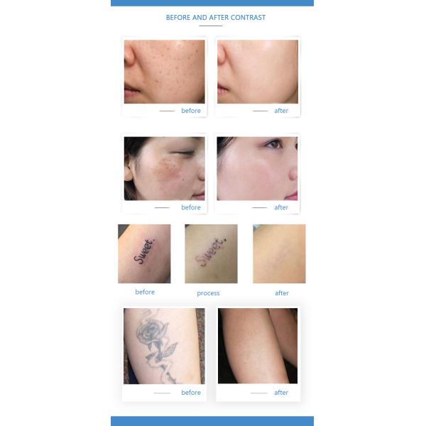 Portable 755nm Pigment Removal Q Switched Nd Yag Laser Tattoo Removal Machine with CE