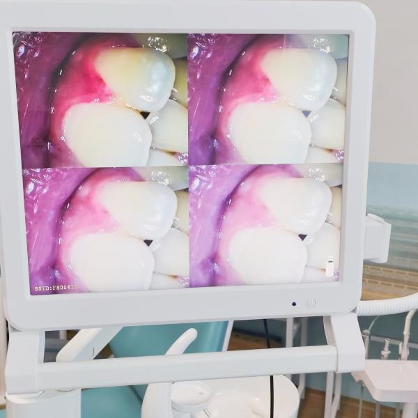 Высокопиксельная стоматологическая камера с 1 или 4 экранами