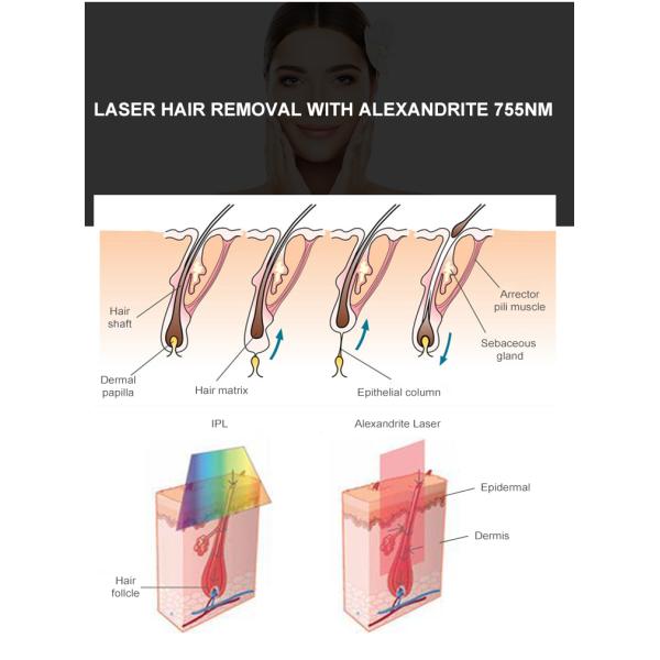 Hair Removal Alexandrite Laser Machine