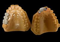 Porcelana de translucidez moderada fundida ao metal PFM Crown, PFM Ceramic Crown