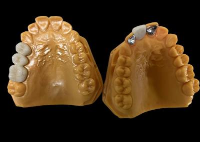 Moderate Translucency Porcelain Fused To Metal PFM Crown , PFM Ceramic Crown