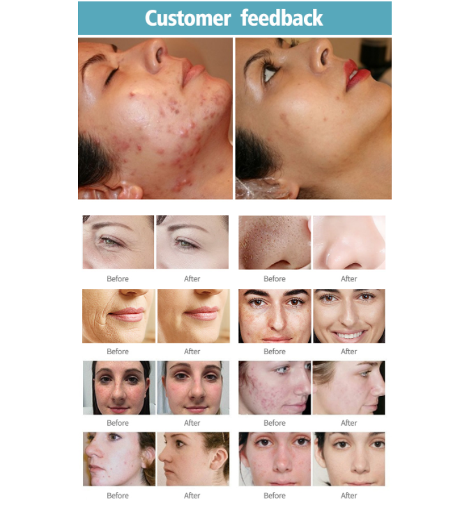 Wrinkle Removal 10600nm Fractional Co2 Laser Machine for Stretchmark Removal