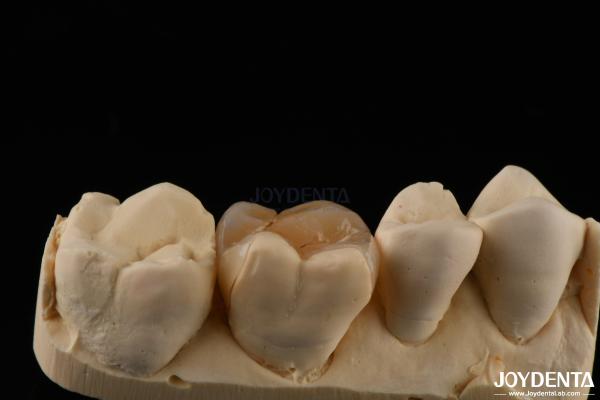 Custom Compound Inlay Onlay For Minimally Invasive Dental Restoration