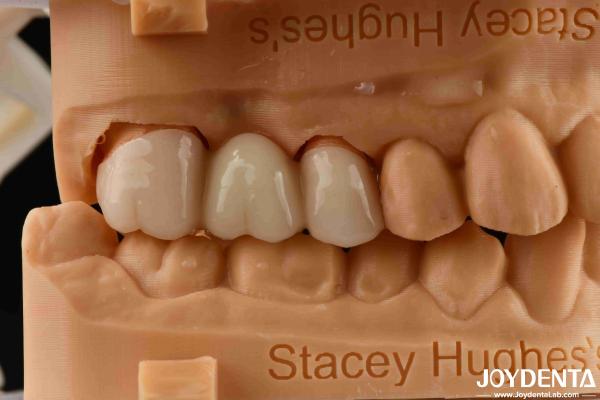 High Flexural Strength Full Contour Zirconia For Crowns Bridges Dental Restoration