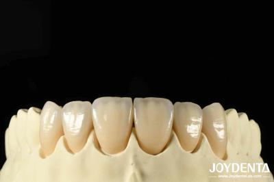 Bionic Development Leaves And Distinct Layers Of Zirconia All-Ceramic