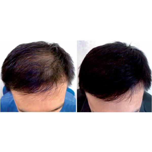 FDA Portable Laser Hair Regrowth Device 650nm 5mW Hair Loss Laser Treatment