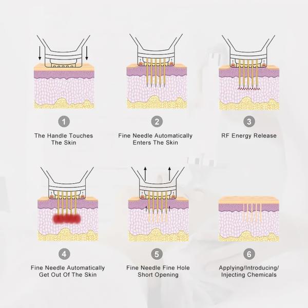 Customized RF Microneedling Machine CE Certified Skin Rejuvenation China Beauty Machine Manufactuer