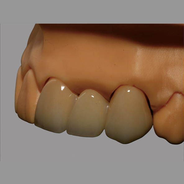 Puente PFZ de cerámica completa biocompatible con sistema CAD/CAM