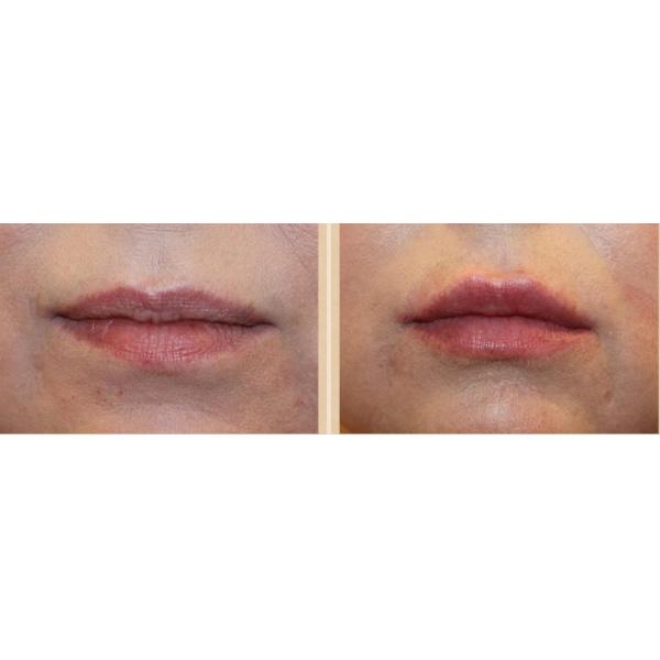 Впрыска заполнителя увеличения губы 2 ML Skinject Hyaluronic кисловочная дермальная