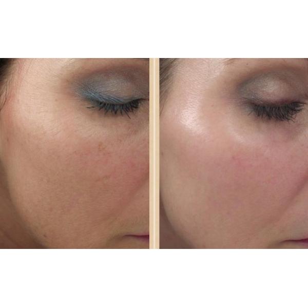 Решение 5 ML Skinject Hyaluronic кисловочное Mesotherapy Moisturizing дермальный заполнитель