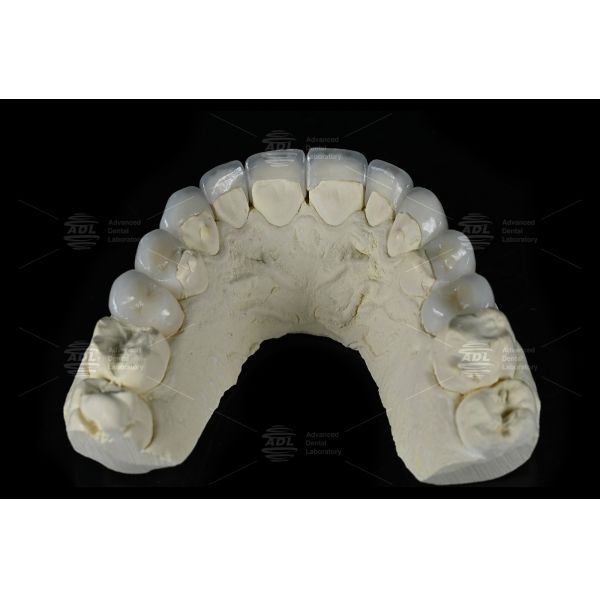 0.3mm-0.7mm Feldspathic EMAX Ceramic Veneers Natural Aesthetic Emax Dental Veneers