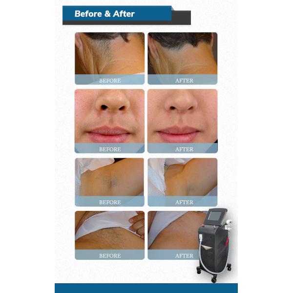 vertical professional diode laser 808nm hair removal machine / Newest Best price 808nm diode laser hair removal machine