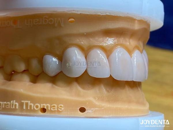 High Permeability Natural Looking Veneers Porcelain Veneers Emax Customized