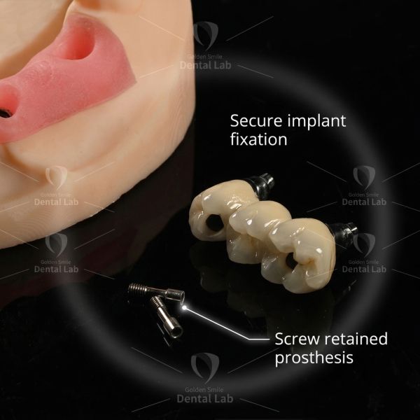 Digital Dental Laboratory PFM Dental Implant Bridge CAD / CAM Precision