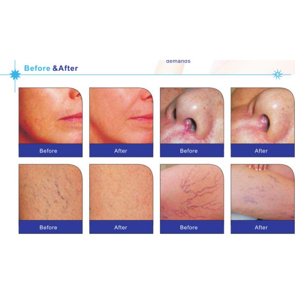 Advanced Vascular Removal Machine 8.4 Inch Color LCD Touch Screen