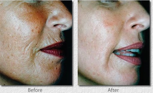 Portable LED PDT Skin Rejuvenation , Acne Treatment Led Light Therapy Professional Equipment