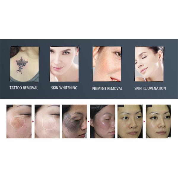 350MJ 600MJ q переключило удаление родинки родимого пятна машины 1320 Nm лазера ND YAG