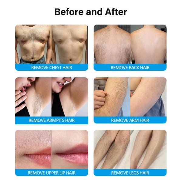 2000W Skin Rejuvenation Painless Hair Removal 808nm Diode Laser Machine