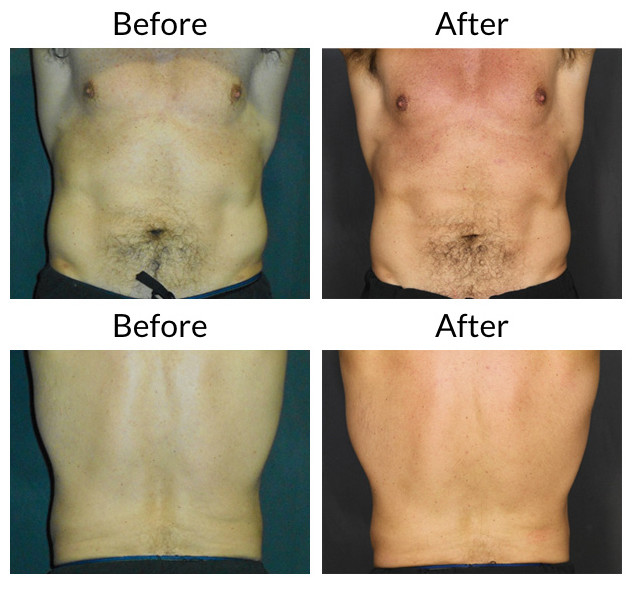 Lcd Cryolipolysis уменьшая вакуум портативной машинки 650nm жирный замерзая уменьшая машину