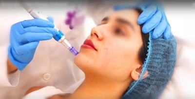 enchimento cutâneo ligado não transversal Ha antienvelhecimento de 20mg/Ml HA para a pena de Hyaluron
